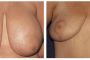 001-001-breast-red